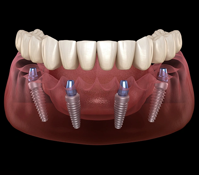 All-On-4 Implants™ Bedford
