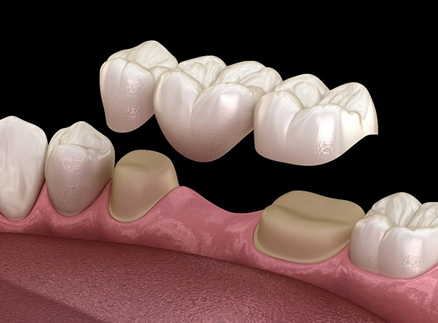 Dental Crowns and Bridges- Maegan Elam, DDS and Associates
