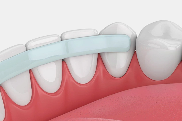 Dental Bonding Bedford