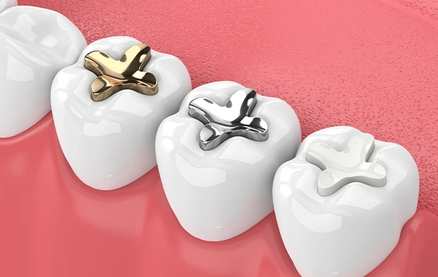 Tooth-Colored Fillings Bedford 