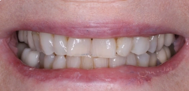 Before Smile Transformation 