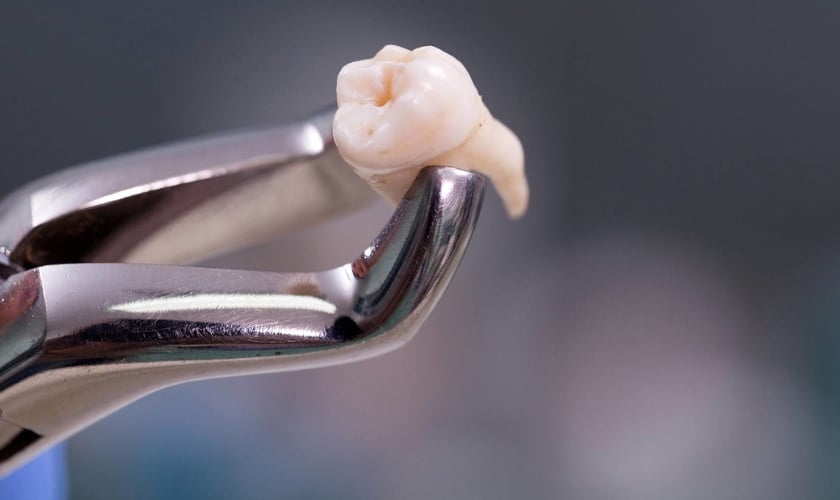 A Guide to a Smooth Tooth Extraction