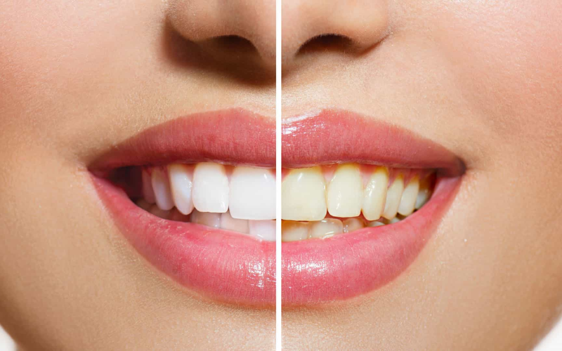 Cosmetic Dentistry Solutions For Discolored Teeth