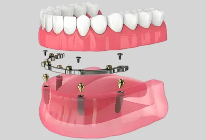 Implant Supported Dentures - Stadium Family Dentistry