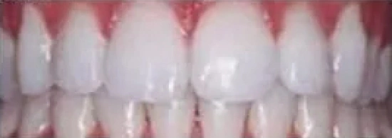 after smile makeover