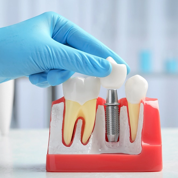 dental implants frisco tx 