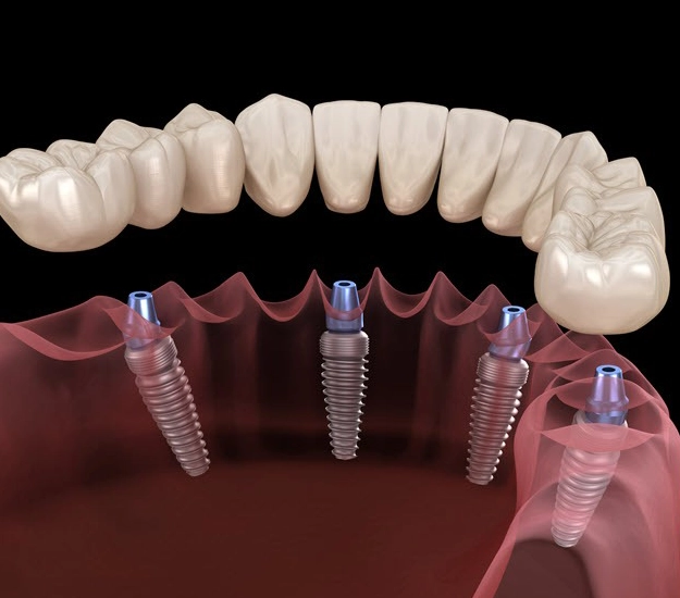 all-on-4 dental implants frisco tx