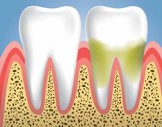 gum disease treatment in frisco