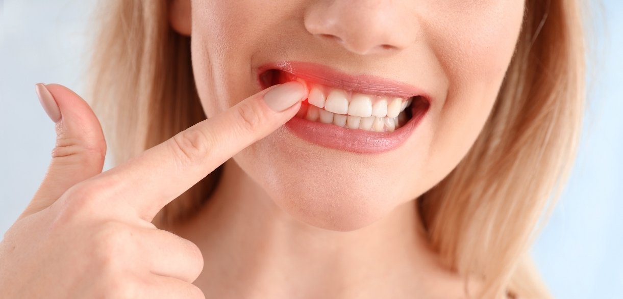 how to stop gum bleeding after dental surgery