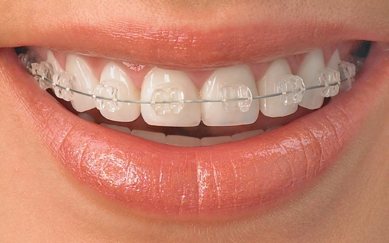 Timeline For Ceramic Braces Treatment