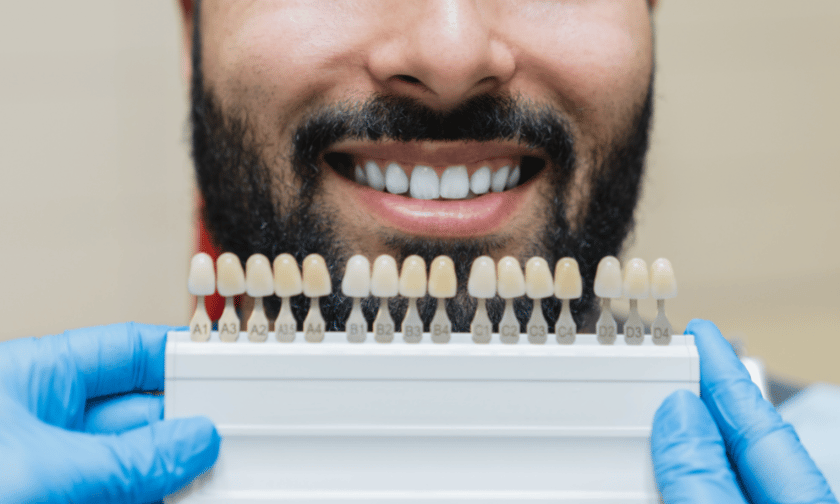 dental-veneers
