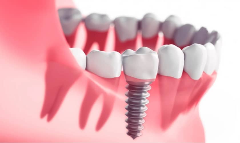 Dental-Implants-in-Los-Angeles