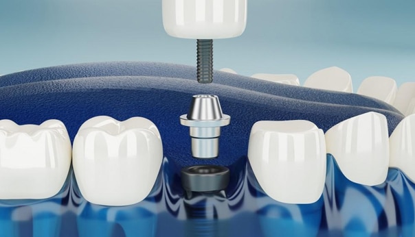 Dental Implant Encino