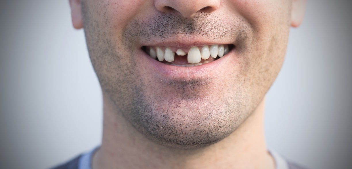 immediate care for broken teeth or abscesses in encino