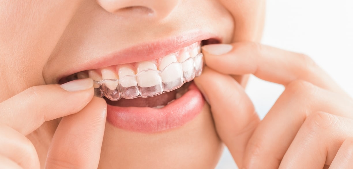 role of lifestyle in your invisalign journey