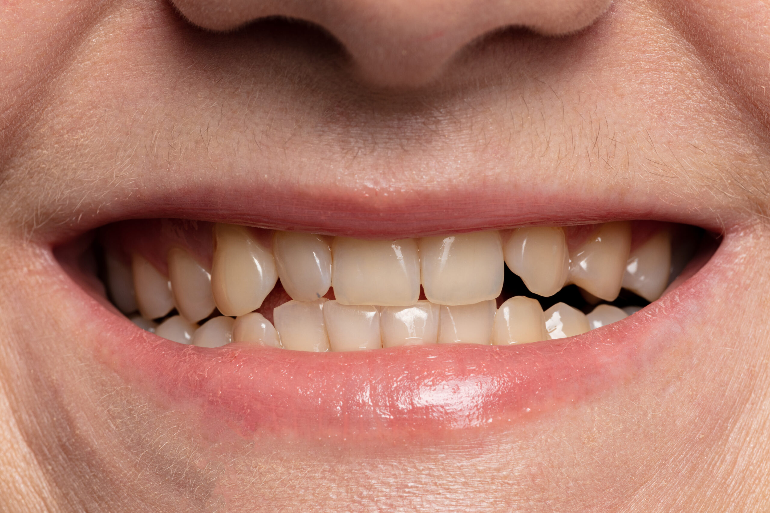 how do you fix a gap between two teeth