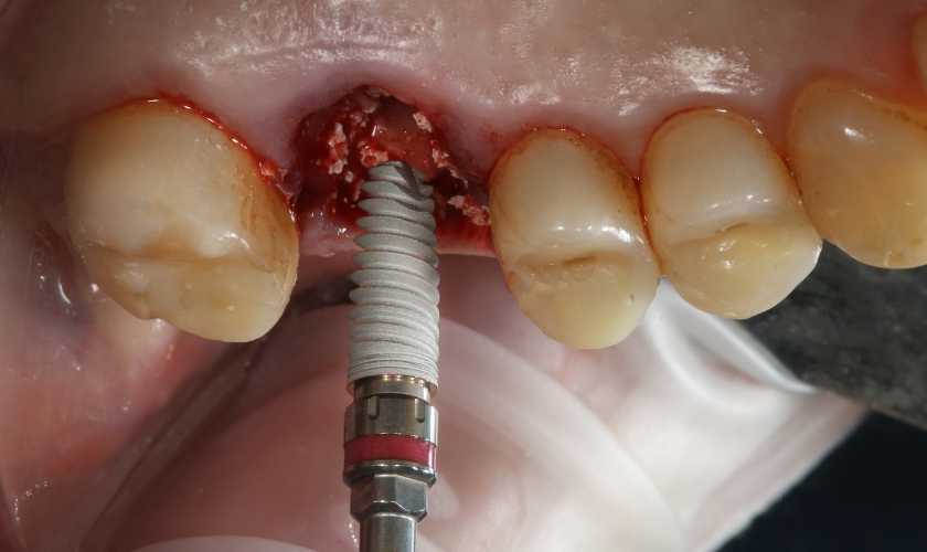 how gums grow and bond to dental implant teeth