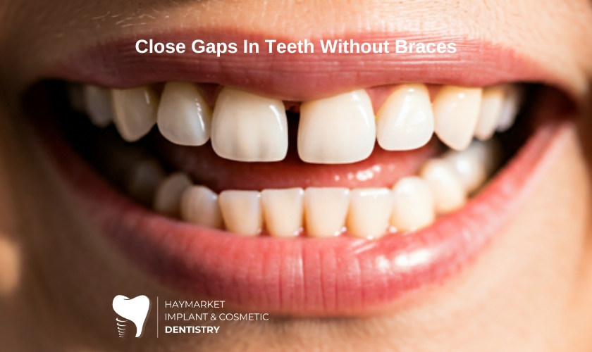 Close Gaps In Teeth Without Braces