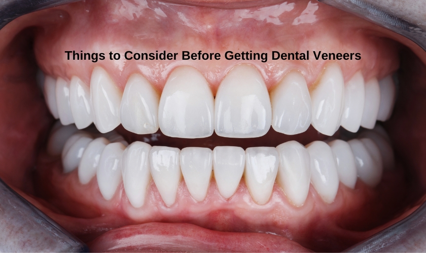 dental veneers considerations