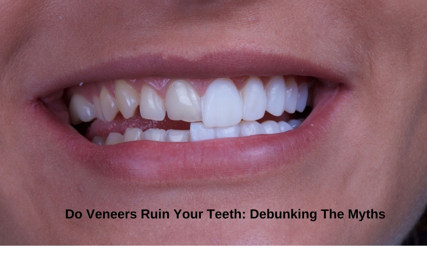 Do Veneers Ruin Your Teeth Debunking The Myths