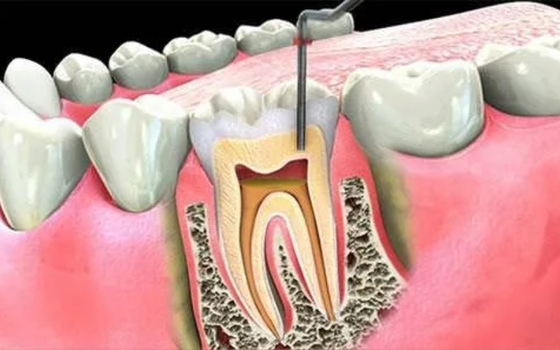 should i pull my molar or have a root canal