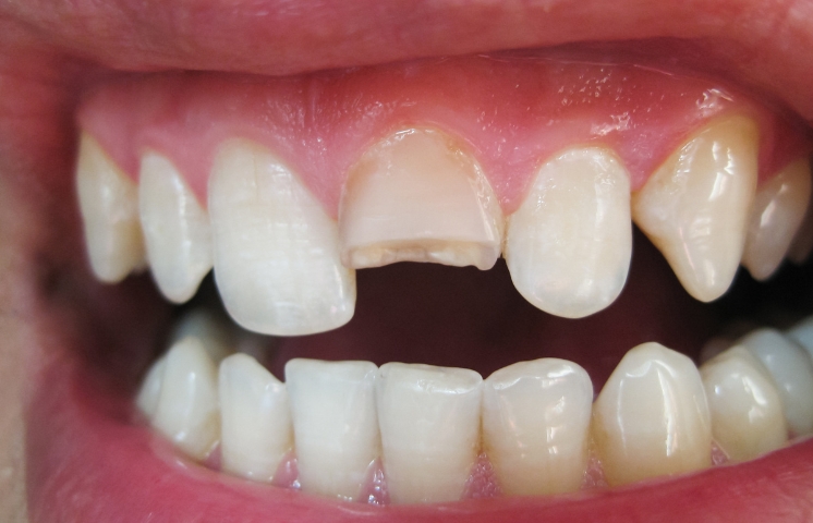 the different treatment options to fix partially broken teeth