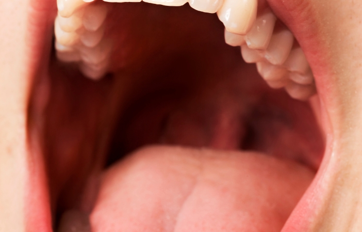 What can be affected if a person has a dry mouth?
