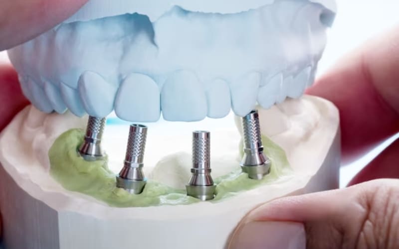 Implant Restoration - Dentistry Of Kingwood, TX