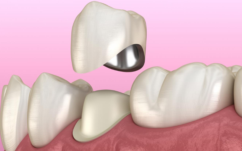 Tips After Getting Dental Crown