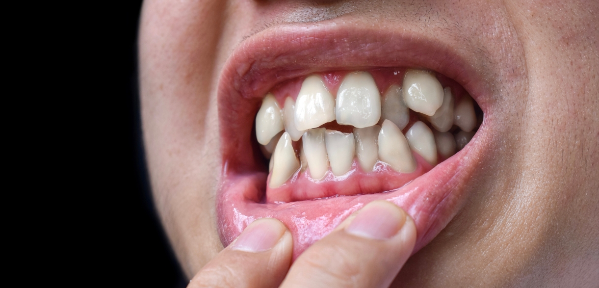 Can A Cosmetic Dentist Fix Your Crooked Teeth
