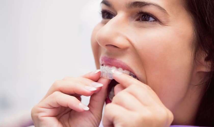 Invisalign