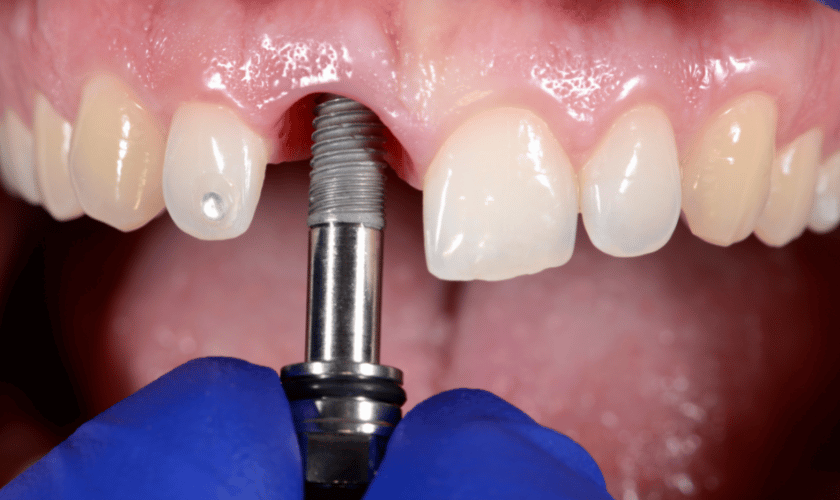 Denture