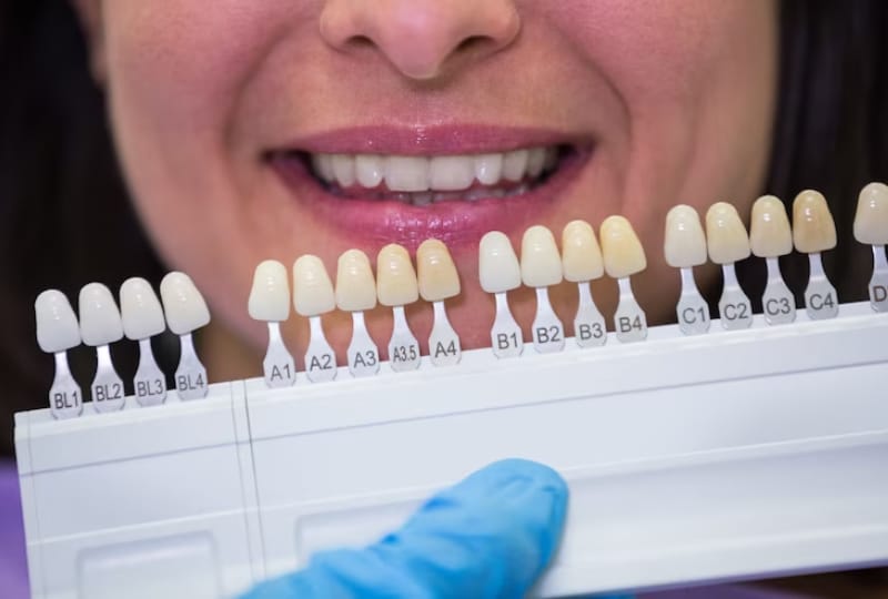 4 Things You Need To Know Before Getting Porcelain Veneers