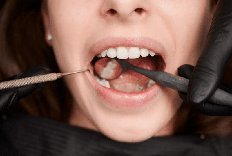 Common Reasons for Tooth Extractions