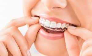 Porcelain Veneers Oak Park - One Fine Smile Dentist in Oak Park