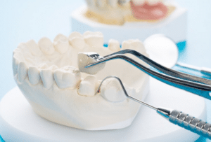The Aesthetic Benefits of Crown Lengthening Procedures