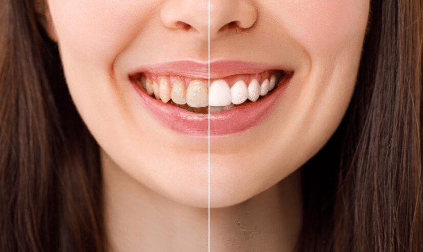 From Coffee Stains to Crystal Clear- How Teeth Whitening Can Reverse Discoloration