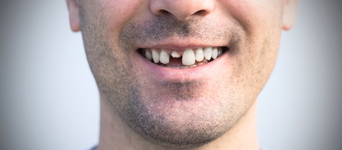 emergency dentist for knocked out tooth