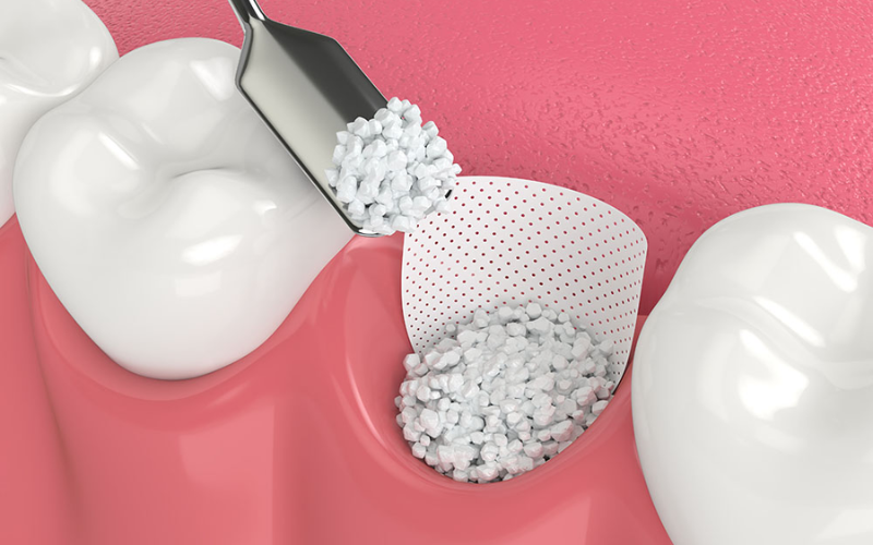 Bone grafting healing