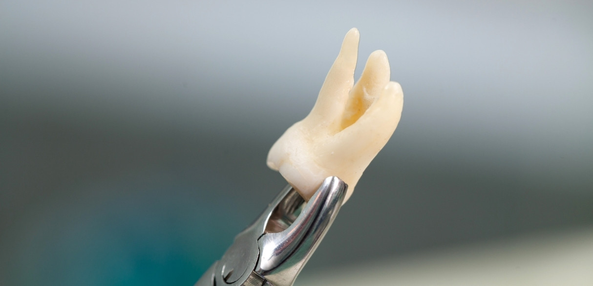 the recovery timeline after wisdom teeth extraction