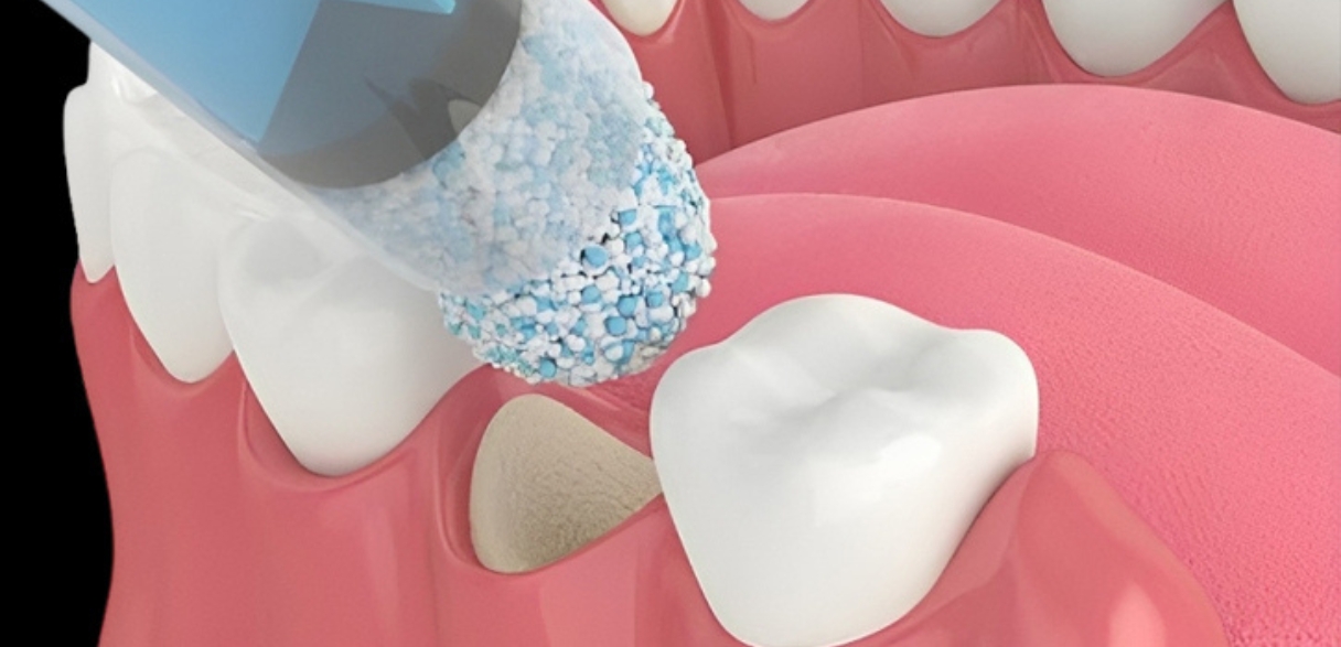 week-by-week timeline of gum graft recovery