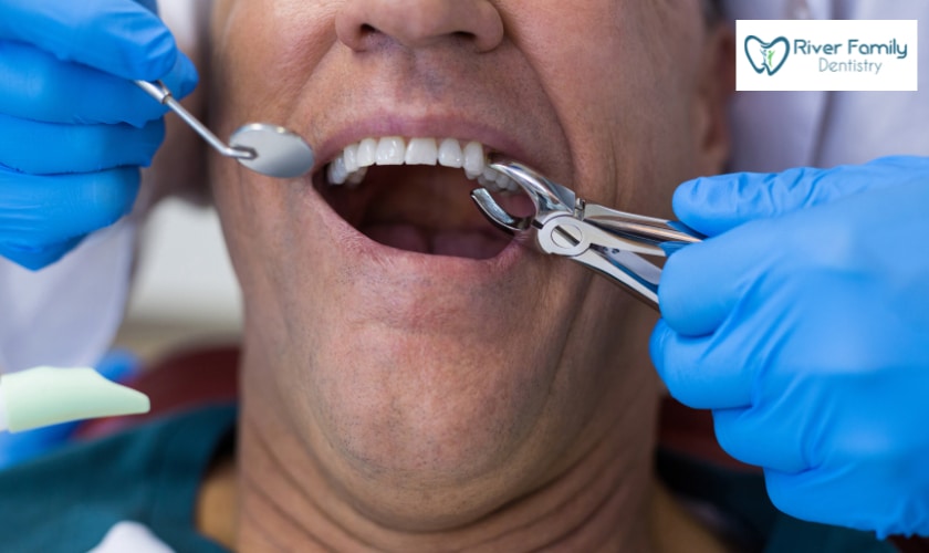 Teeth Extraction vs Preservation