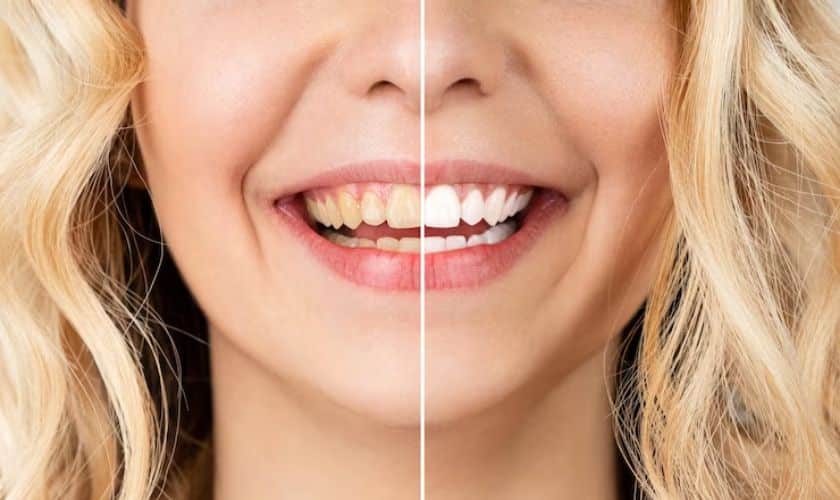 Know the Difference: Teeth Cleaning vs. Teeth Whitening