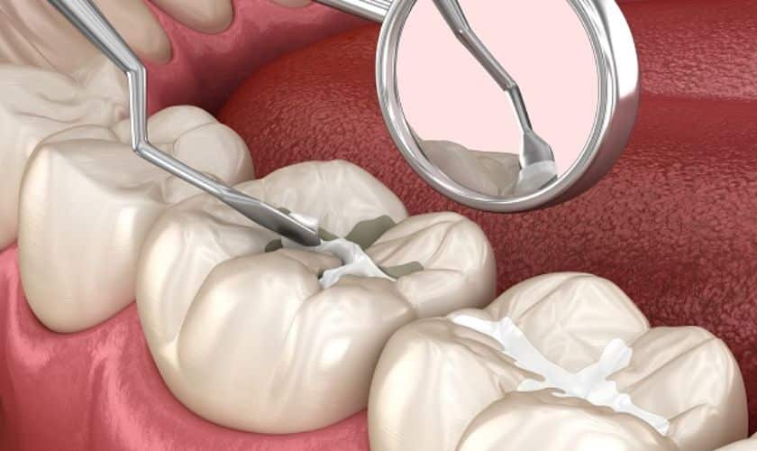 Preserving Freedom: Dental Sealants And Preventive Dental Care