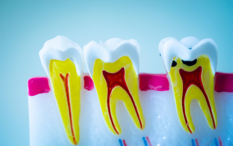 How To Know If You Need Root Canal Treatment