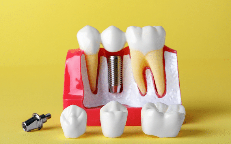 Must-Have Oral Hygiene Products For Maintaining Dental Implants