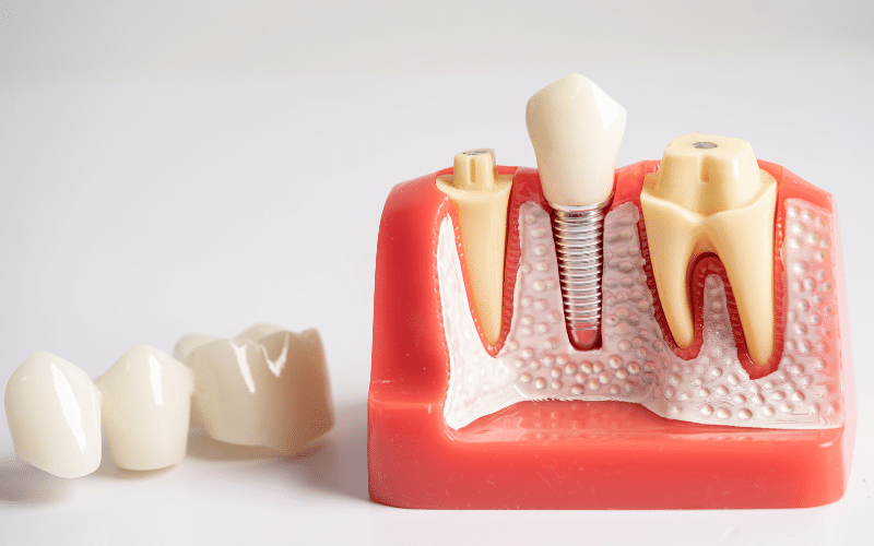 root canals and crowns are they necessary