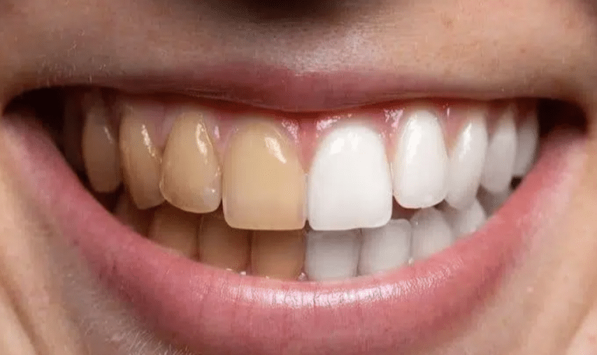 6 ways to remove coffee stains from your teeth