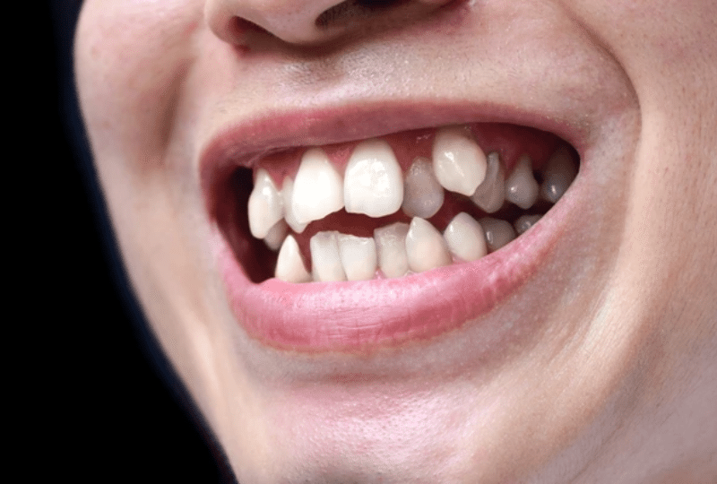 Overlapping Teeth