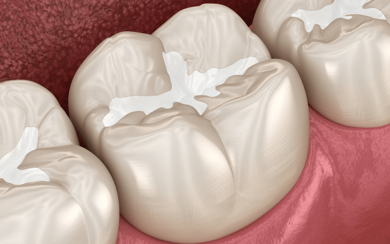 How Dental Sealants Complete Your Preventive Care